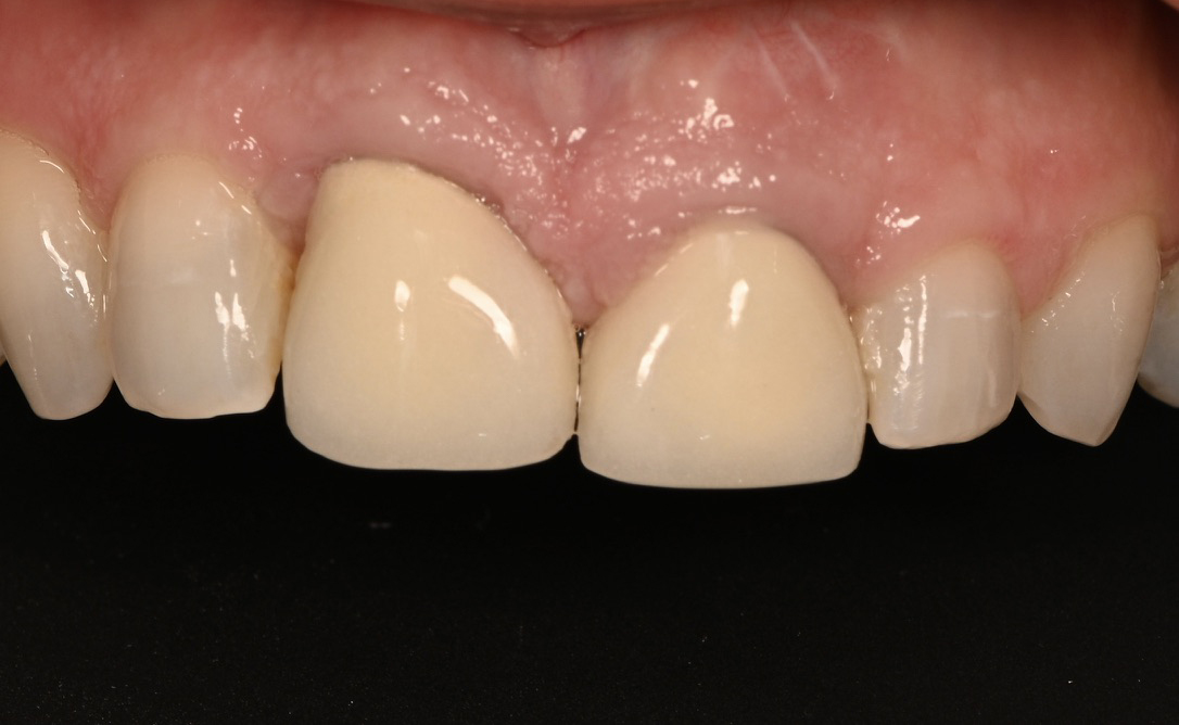 Gingival Height Discrepancy